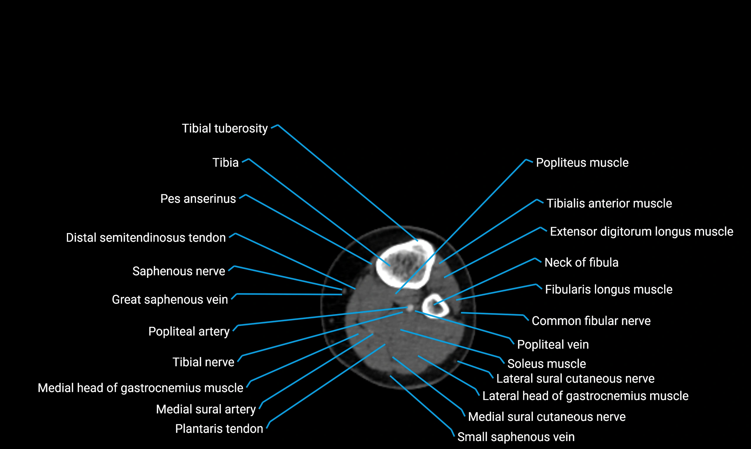 CT lower limb axial cross sectional anatomy labelled image 99 (2).webp